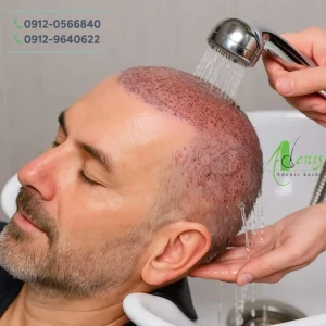 اسپری کردن آب به محل کاشت مو