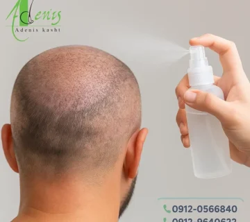 آب پاشی سر بعد از کاشت مو