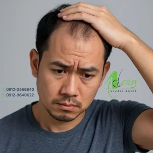 کاشت مو با بیمه