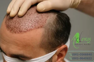 کاشت مو با بیمه تامین اجتماعی