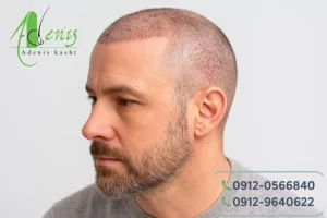 تفاوت کاشت مو یک روزه با دو روزه