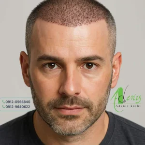 کاشت مو دو روزه