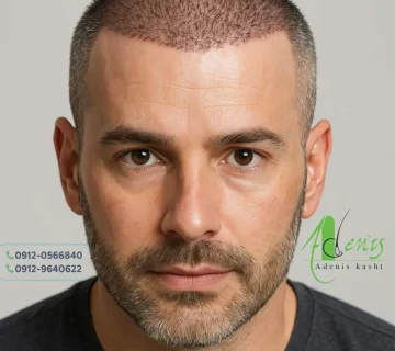 کاشت مو دو روزه