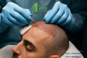 کاشت مو دو مرحله ای دو روزه