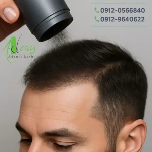 استفاده از تاپیک بعد از کاشت مو