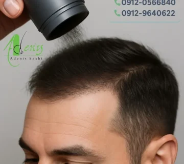 استفاده از تاپیک بعد از کاشت مو