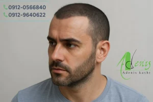 عوارض استفاده از تاپیک بعد از کاشت مو