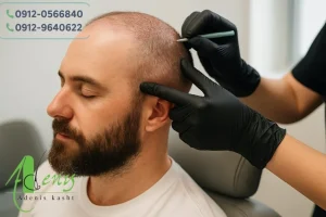 بی حس ماندن سر بعد از کاشت مو