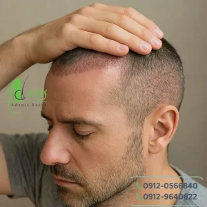 بی حسی سر بعد از کاشت مو