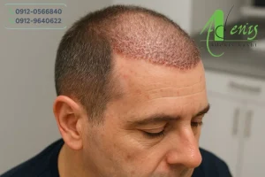 بیهوشی در عمل کاشت مو