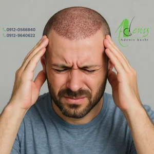 سردرد بعد از کاشت مو