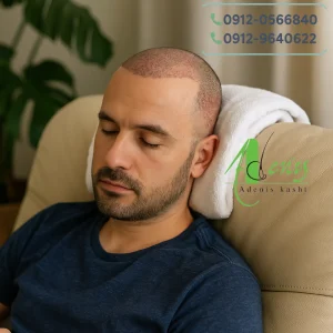 مدت زمان استراحت بعد از کاشت مو