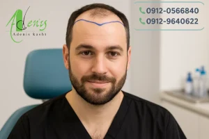 آیا کاشت مو با بیماری صرع امکان پذیر است ؟