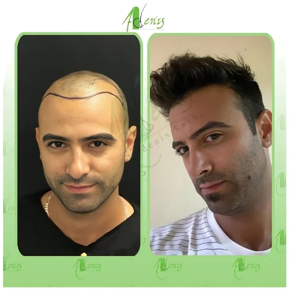 نمونه کاشت مو