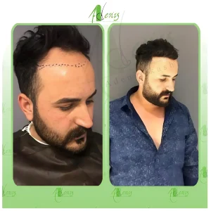 نمونه کار کاشت مو