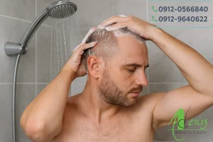 نحوه حمام رفتن بعد از کاشت مو