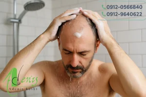 شستشو بدن و حمام بعد از کاشت مو