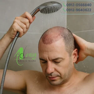 حمام رفتن بعد از کاشت مو