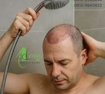 حمام رفتن بعد از کاشت مو