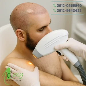 لیزر موهای زائد بعد از کاشت مو