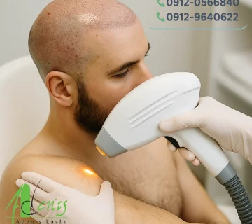 لیزر موهای زائد بعد از کاشت مو