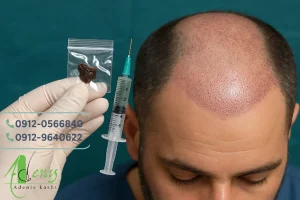 مصرف تریاک و کاشت مو