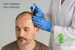 مصرف تریاک قبل و بعد از کاشت مو