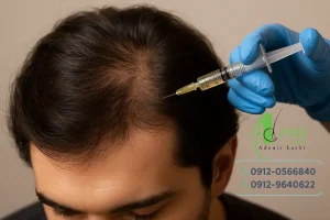 کاشت مو در لابلای موها