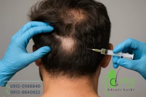 آیا کاشت مو در لابلای مو ها امکان پذیر است ؟