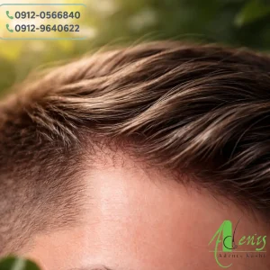 کاشت مو با خواب طبیعی