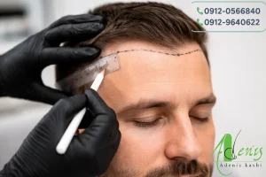 کاشت مو با خواب کاملا طبیعی