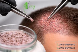 کاشت مو با خواب طبیعی در تهران