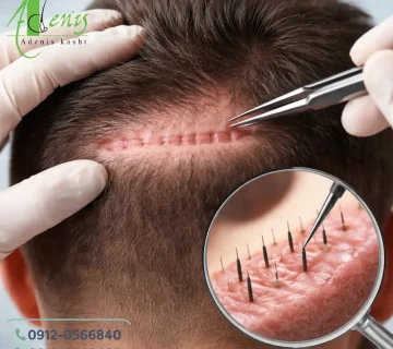 کاشت مو در محل جای زخم