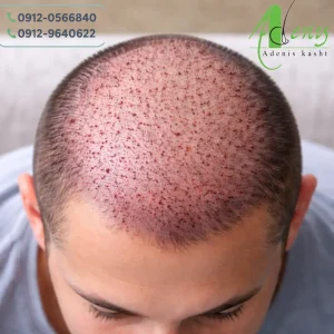 دوره نقاهت کاشت مو