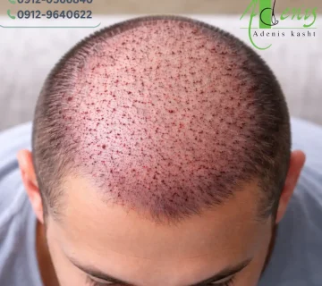 دوره نقاهت کاشت مو