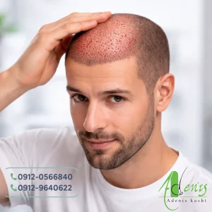 خون آمدن بعد از کاشت مو