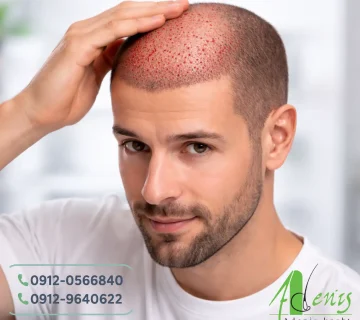 خون آمدن بعد از کاشت مو