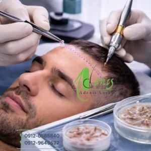 کاشت مو به روش Super fue