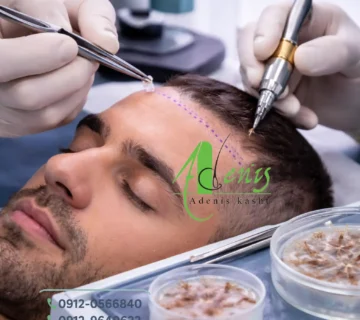 کاشت مو به روش Super fue