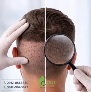 ترمیم محل برداشت مو