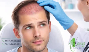 پیشگیری از عفونت بعد از کاشت مو