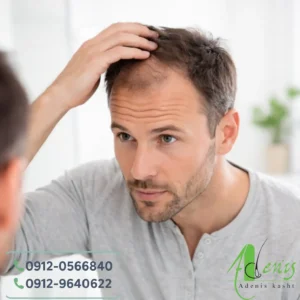 کاهش تراکم مو در حال بررسی خط رویش مقابل آینه