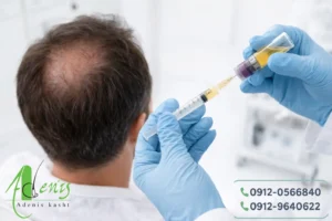 آماده‌سازی درمان تزریقی برای تقویت رشد مو در محیط پزشکی