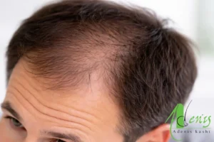 کم پشت شدن و نازک شدن موی سر