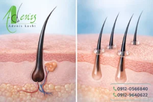 مقایسه کاشت مو با الیاف نانو و پیوند فولیکول طبیعی