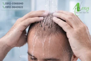 نحوه شستشوی صحیح بعد از کاشت مو با الیاف نانو