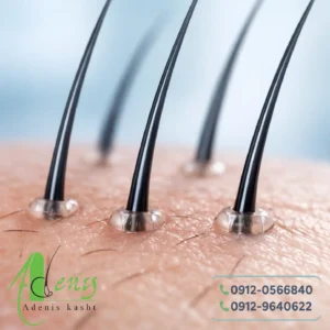 کاشت مو با الیاف نانو نمای نزدیک از قرارگیری الیاف در پوست سر