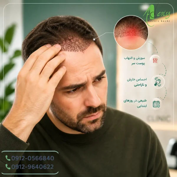 سوزش بعد از کاشت مو و احساس التهاب پوست سر در روزهای ابتدایی