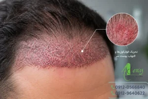 علت سوزش بعد از کاشت مو به دلیل تحریک پوست و فولیکول‌ها