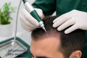 نتیجه طبیعی کاشت مو با روش neoGraft